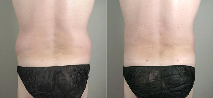 Liposuction Case 780 Before & After View #2 | Paramus, New Jersey | Parker Center for Plastic Surgery