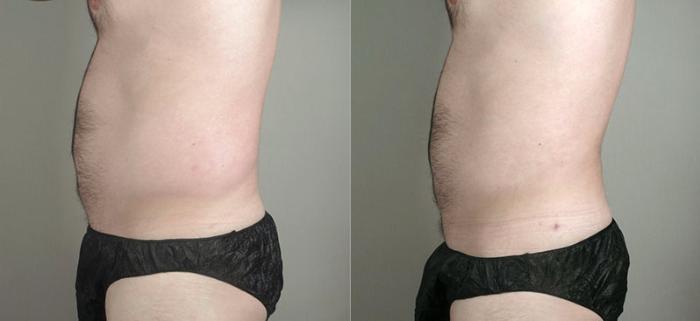 Liposuction Case 780 Before & After View #3 | Paramus, New Jersey | Parker Center for Plastic Surgery
