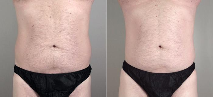 Liposuction Case 781 Before & After View #1 | Paramus, New Jersey | Parker Center for Plastic Surgery