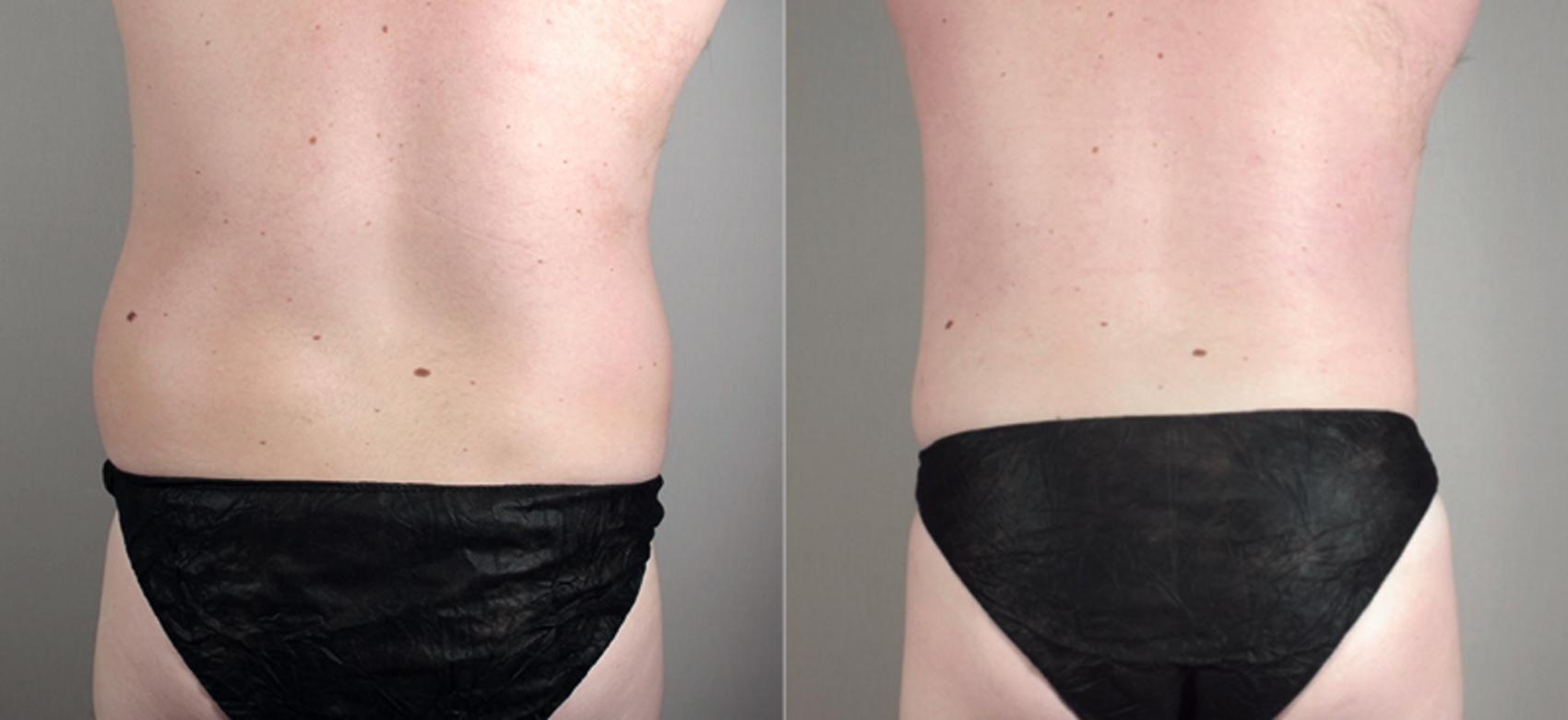 Liposuction Case 781 Before & After View #2 | Paramus, New Jersey | Parker Center for Plastic Surgery