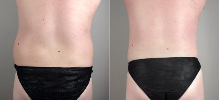 Liposuction Case 781 Before & After View #2 | Paramus, New Jersey | Parker Center for Plastic Surgery