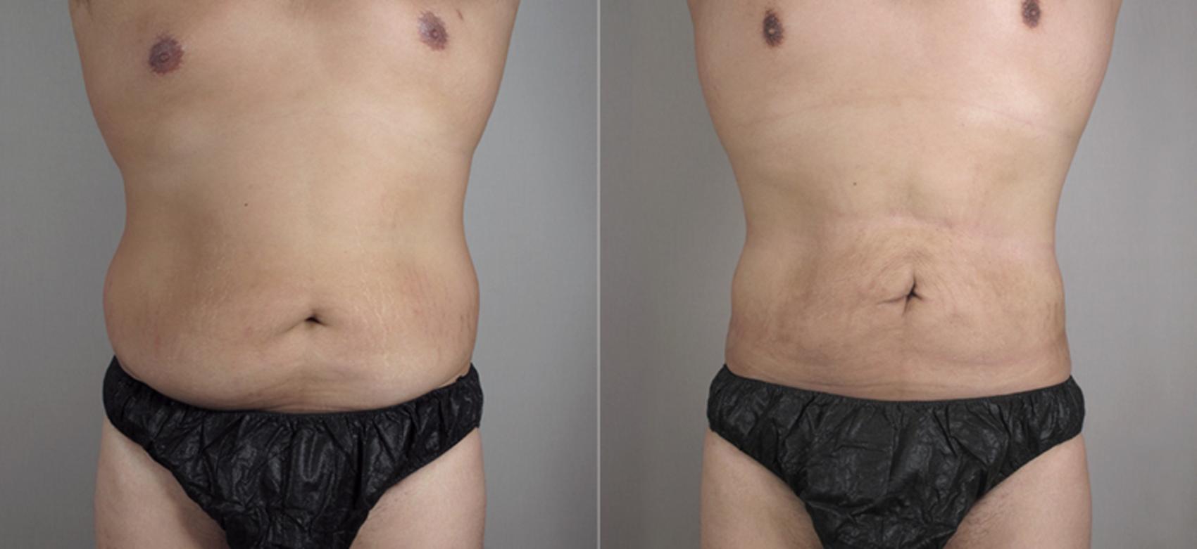 Liposuction Case 782 Before & After View #1 | Paramus, New Jersey | Parker Center for Plastic Surgery