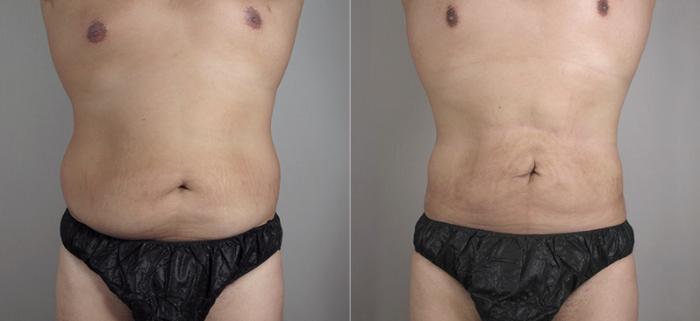 Liposuction Case 782 Before & After View #1 | Paramus, New Jersey | Parker Center for Plastic Surgery