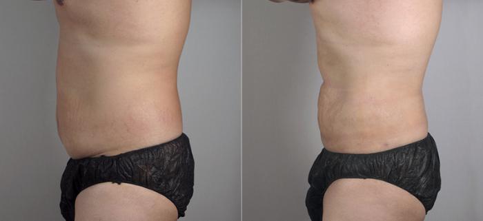 Liposuction Case 782 Before & After View #2 | Paramus, New Jersey | Parker Center for Plastic Surgery
