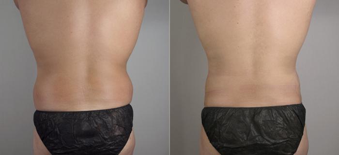 Liposuction Case 782 Before & After View #3 | Paramus, New Jersey | Parker Center for Plastic Surgery