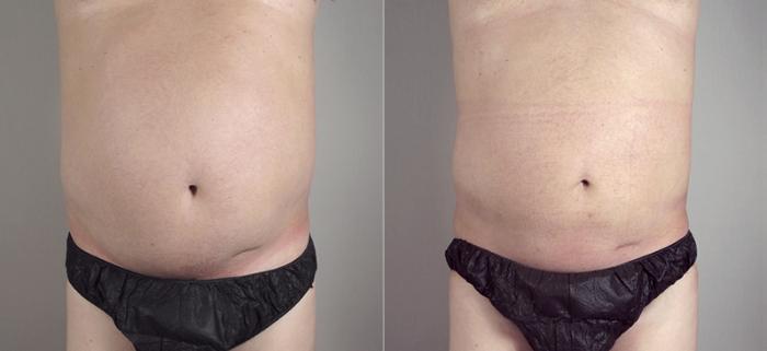 Liposuction Case 783 Before & After View #1 | Paramus, New Jersey | Parker Center for Plastic Surgery