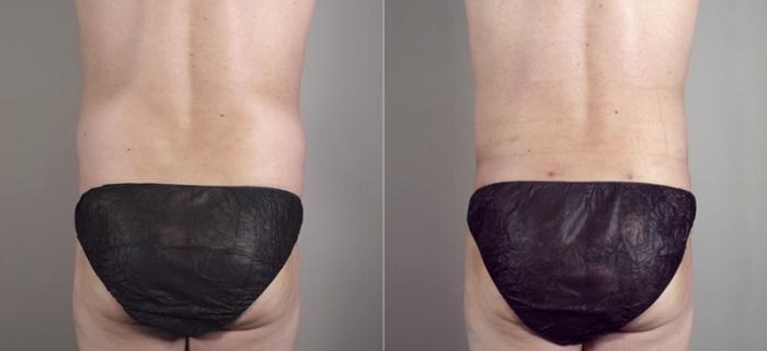 Liposuction Case 783 Before & After View #3 | Paramus, New Jersey | Parker Center for Plastic Surgery