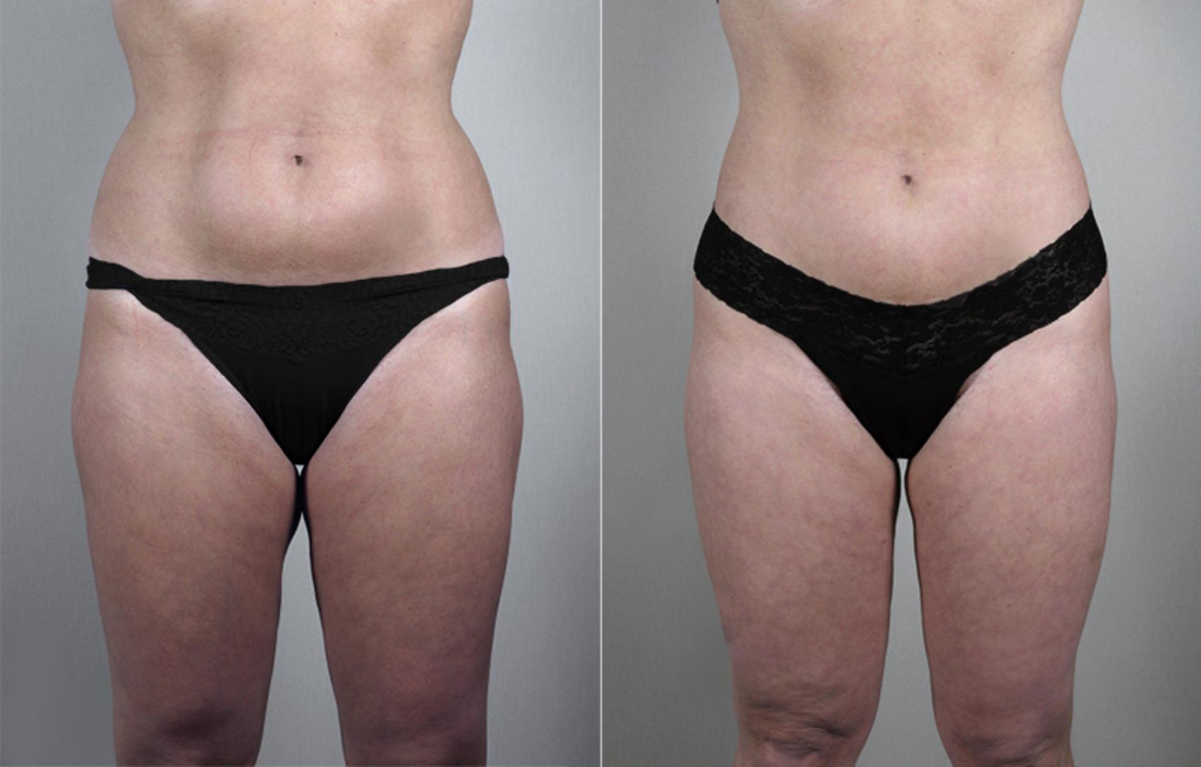 Liposuction Case 784 Before & After View #1 | Paramus, New Jersey | Parker Center for Plastic Surgery