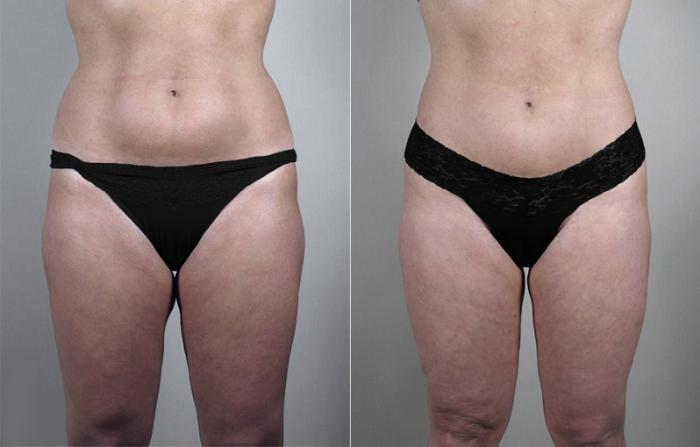 Liposuction Case 784 Before & After View #1 | Paramus, New Jersey | Parker Center for Plastic Surgery