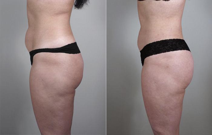 Liposuction Case 784 Before & After View #2 | Paramus, New Jersey | Parker Center for Plastic Surgery