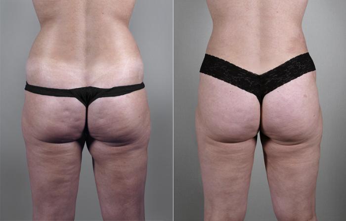 Liposuction Case 784 Before & After View #3 | Paramus, New Jersey | Parker Center for Plastic Surgery