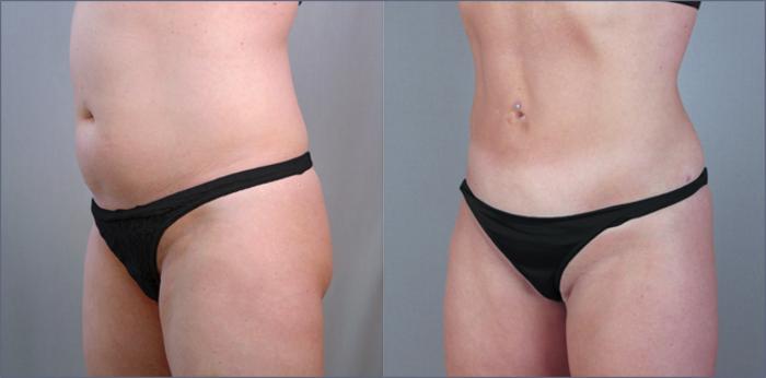 Liposuction Case 785 Before & After View #2 | Paramus, New Jersey | Parker Center for Plastic Surgery