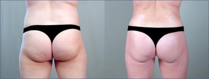 Liposuction Case 785 Before & After View #4 | Paramus, New Jersey | Parker Center for Plastic Surgery