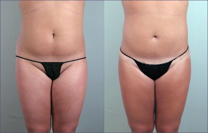 Liposuction Case 786 Before & After View #1 | Paramus, New Jersey | Parker Center for Plastic Surgery