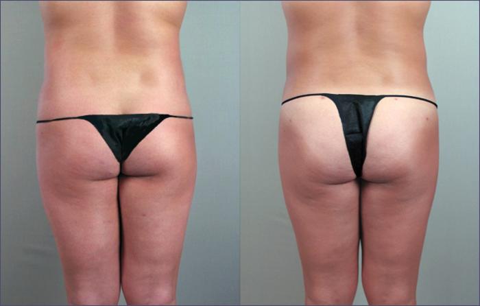 Liposuction Case 786 Before & After View #2 | Paramus, New Jersey | Parker Center for Plastic Surgery
