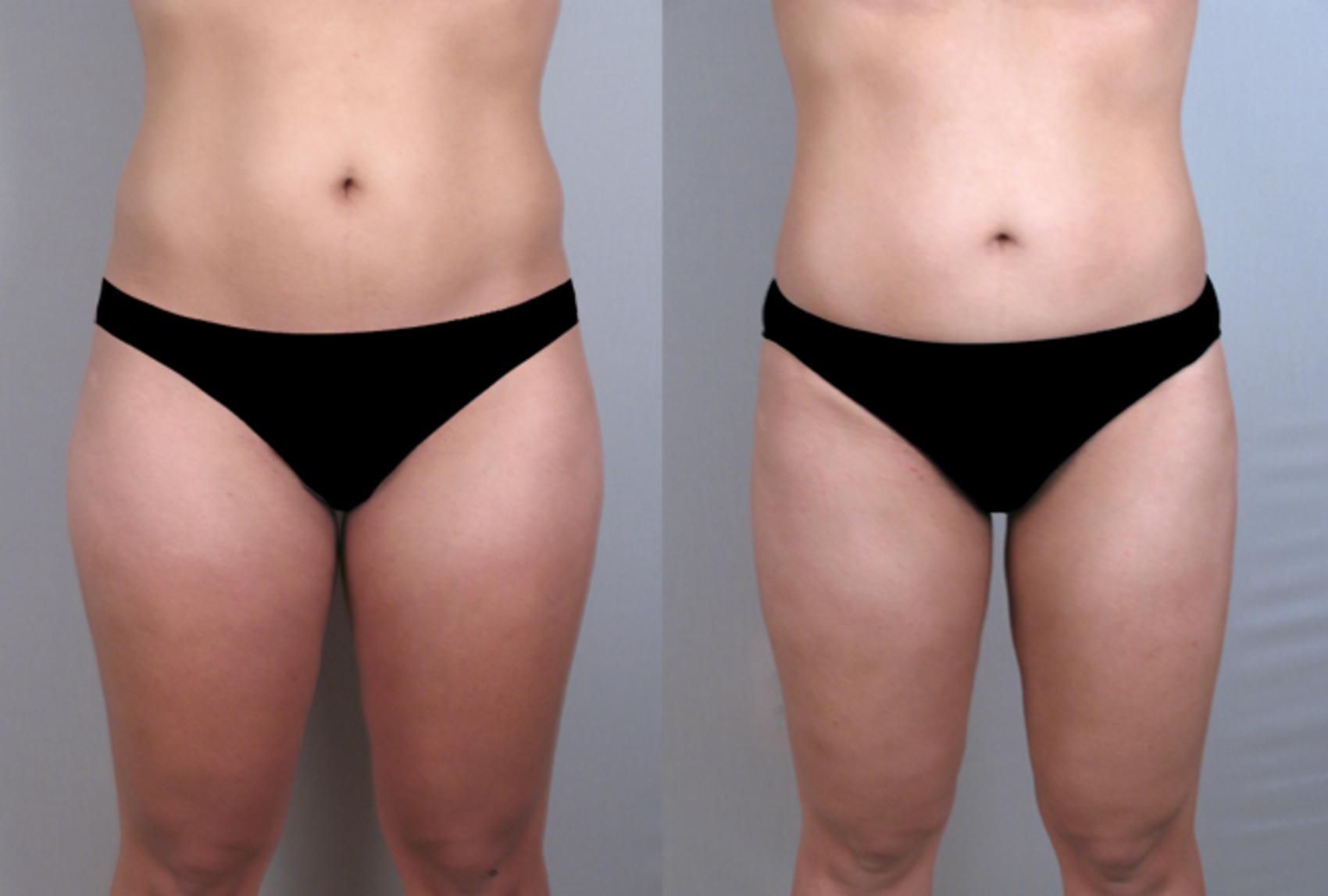 Liposuction Case 787 Before & After View #1 | Paramus, New Jersey | Parker Center for Plastic Surgery