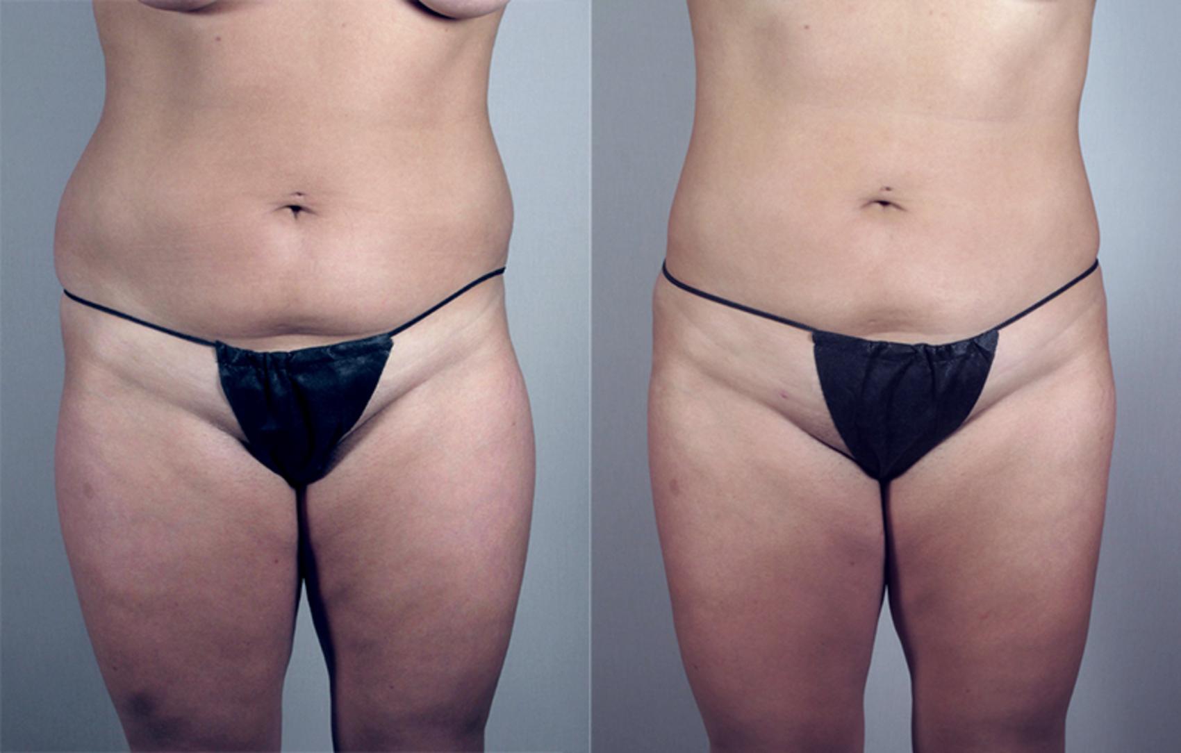Liposuction Case 788 Before & After View #1 | Paramus, New Jersey | Parker Center for Plastic Surgery