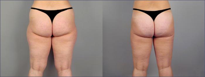Liposuction Case 789 Before & After View #2 | Paramus, New Jersey | Parker Center for Plastic Surgery