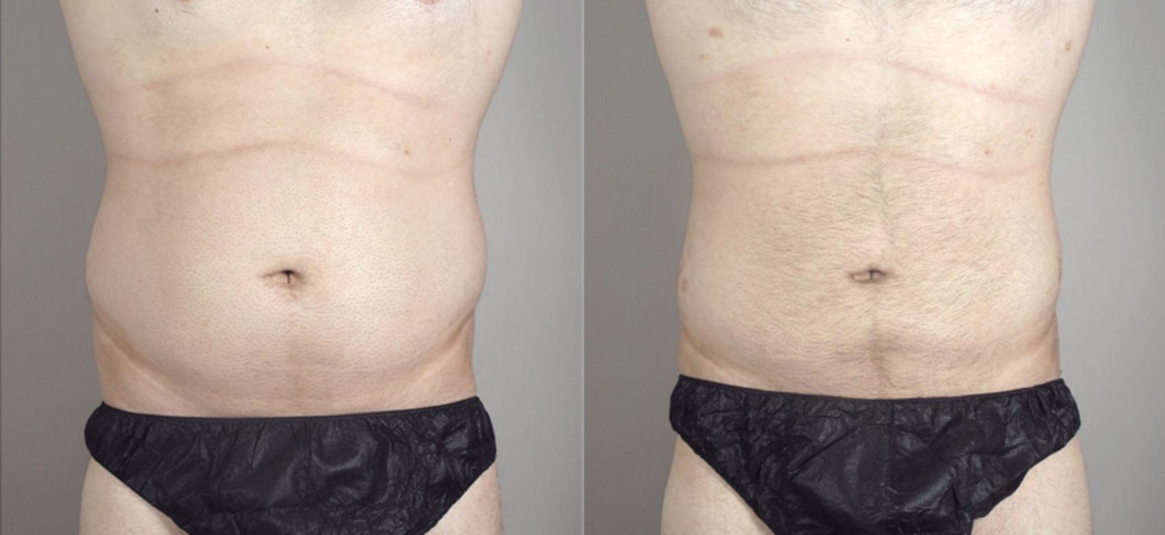 Liposuction Case 790 Before & After View #1 | Paramus, New Jersey | Parker Center for Plastic Surgery