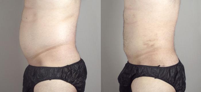 Liposuction Case 790 Before & After View #2 | Paramus, New Jersey | Parker Center for Plastic Surgery