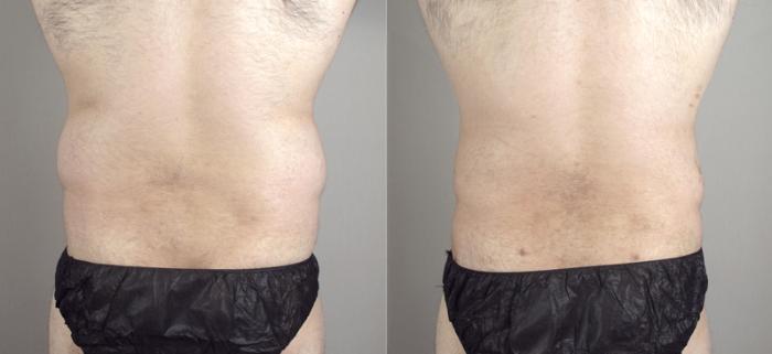 Liposuction Case 790 Before & After View #3 | Paramus, New Jersey | Parker Center for Plastic Surgery