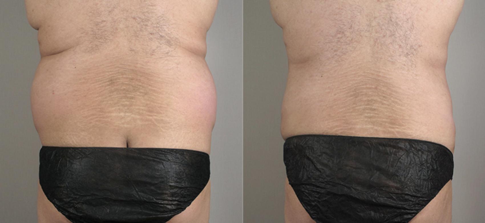 Liposuction Case 792 Before & After View #1 | Paramus, New Jersey | Parker Center for Plastic Surgery