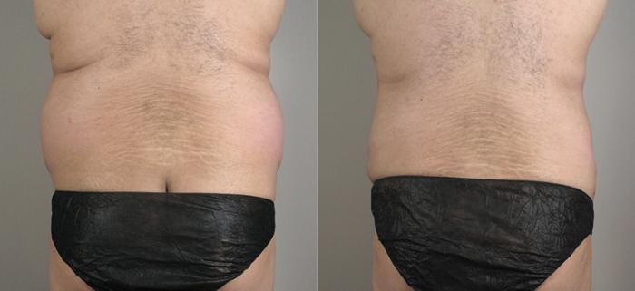 Liposuction Case 792 Before & After View #1 | Paramus, New Jersey | Parker Center for Plastic Surgery