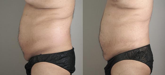 Liposuction Case 792 Before & After View #2 | Paramus, New Jersey | Parker Center for Plastic Surgery