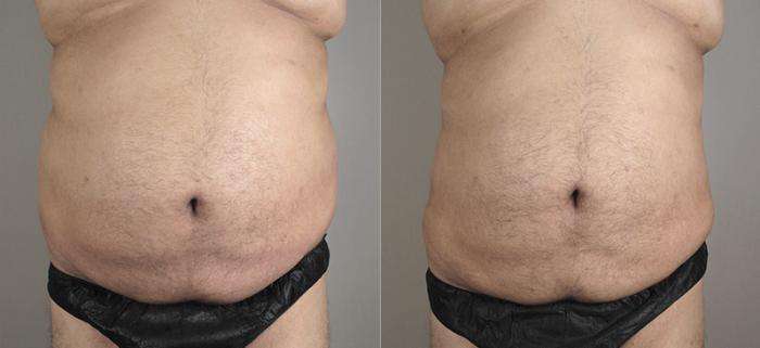 Liposuction Case 792 Before & After View #3 | Paramus, New Jersey | Parker Center for Plastic Surgery