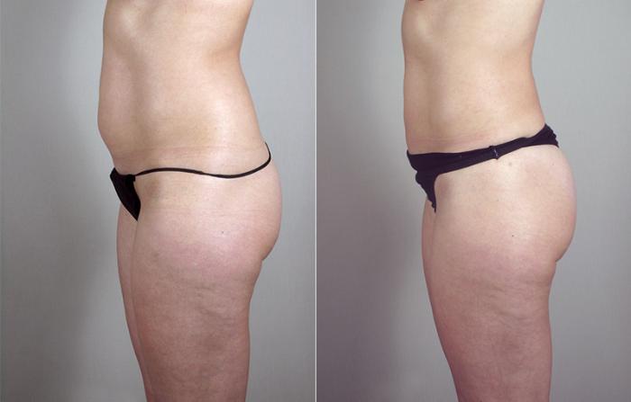 Liposuction Case 793 Before & After View #2 | Paramus, New Jersey | Parker Center for Plastic Surgery