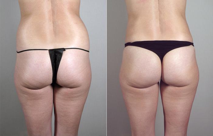Liposuction Case 793 Before & After View #3 | Paramus, New Jersey | Parker Center for Plastic Surgery