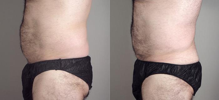 Liposuction Case 794 Before & After View #2 | Paramus, New Jersey | Parker Center for Plastic Surgery