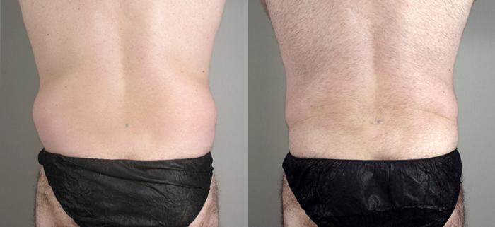 Liposuction Case 794 Before & After View #3 | Paramus, New Jersey | Parker Center for Plastic Surgery