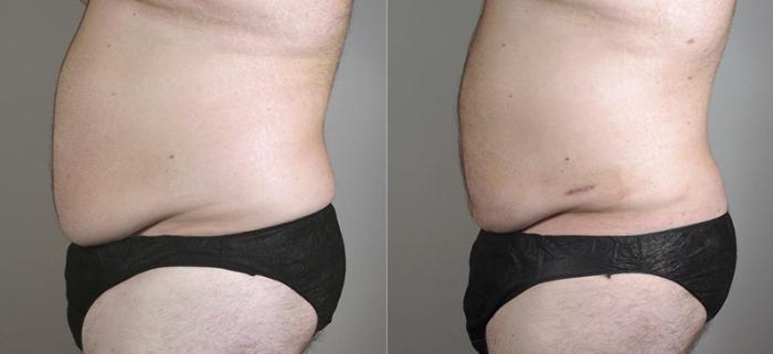 Liposuction Case 795 Before & After View #2 | Paramus, New Jersey | Parker Center for Plastic Surgery