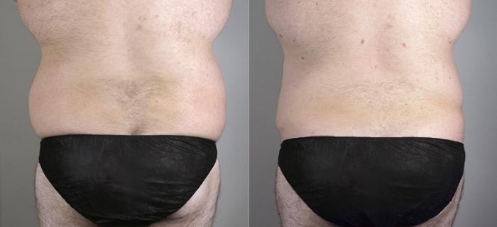 Liposuction Case 795 Before & After View #3 | Paramus, New Jersey | Parker Center for Plastic Surgery