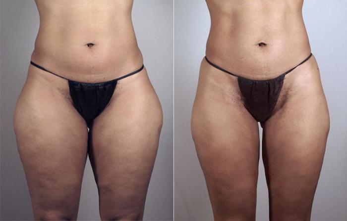 Liposuction Case 796 Before & After View #1 | Paramus, New Jersey | Parker Center for Plastic Surgery