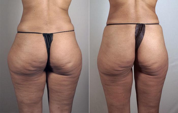 Liposuction Case 796 Before & After View #2 | Paramus, New Jersey | Parker Center for Plastic Surgery