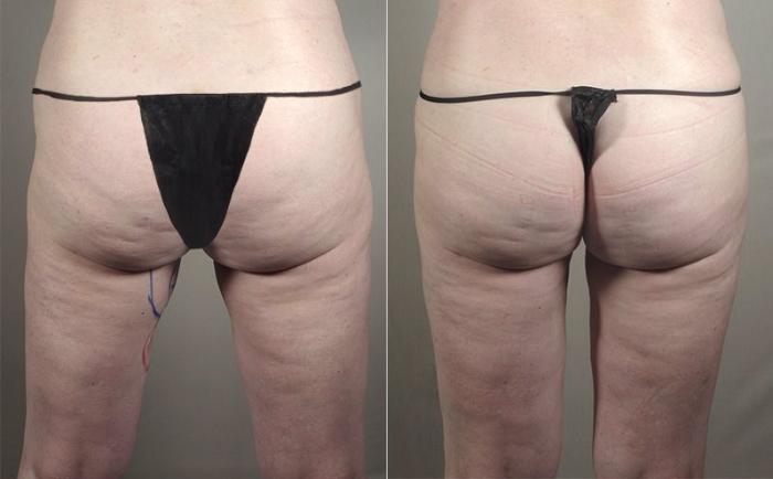 Liposuction Case 798 Before & After View #1 | Paramus, New Jersey | Parker Center for Plastic Surgery