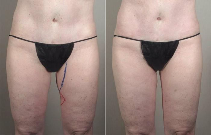 Liposuction Case 798 Before & After View #2 | Paramus, New Jersey | Parker Center for Plastic Surgery