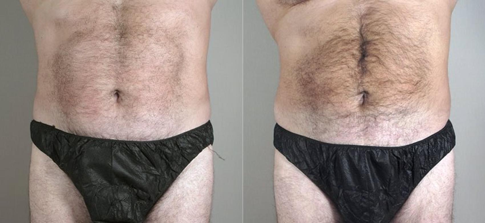 Liposuction Case 800 Before & After View #1 | Paramus, New Jersey | Parker Center for Plastic Surgery