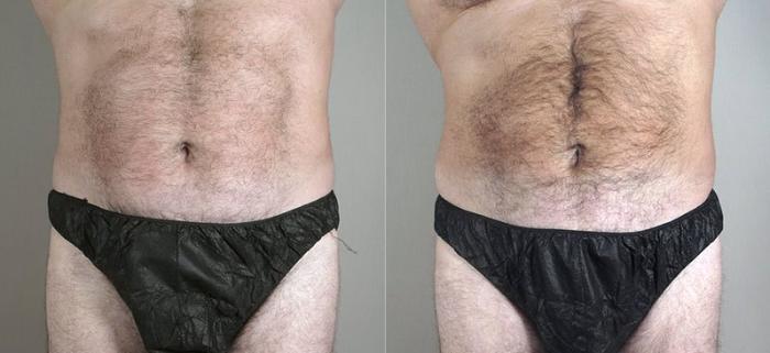 Liposuction Case 800 Before & After View #1 | Paramus, New Jersey | Parker Center for Plastic Surgery