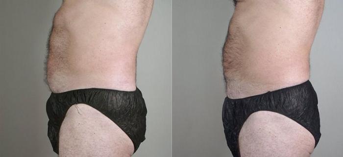 Liposuction Case 800 Before & After View #2 | Paramus, New Jersey | Parker Center for Plastic Surgery