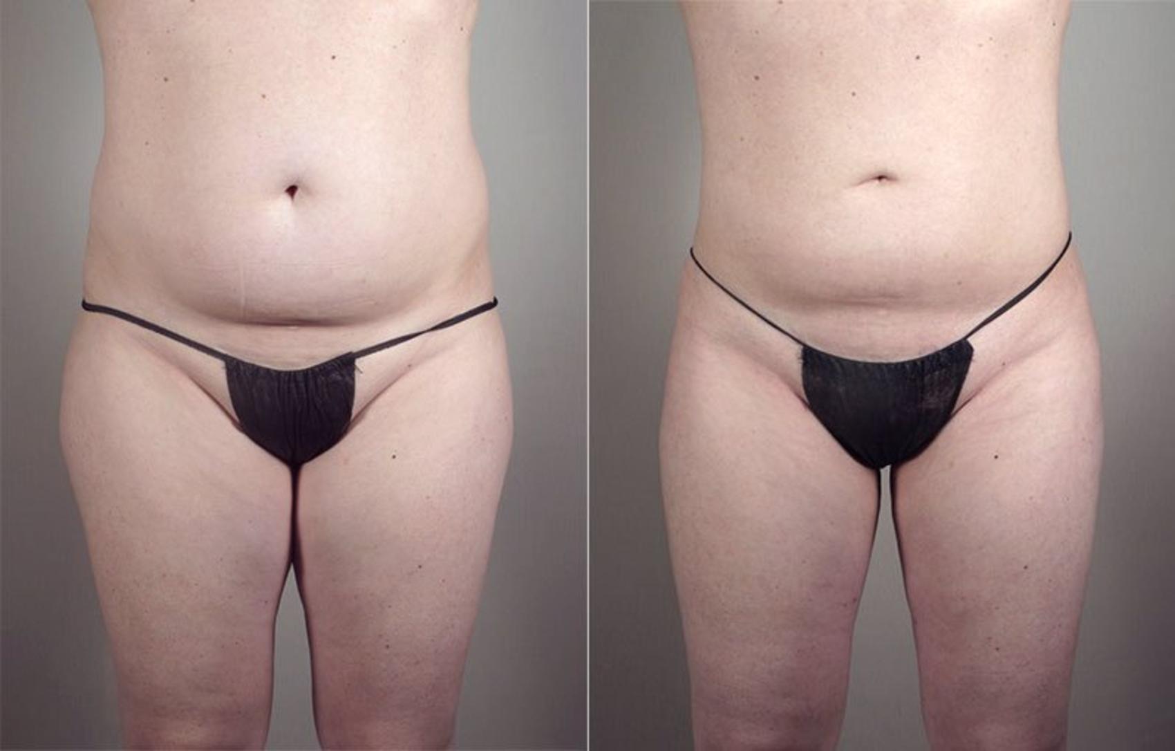 Liposuction Case 801 Before & After View #1 | Paramus, New Jersey | Parker Center for Plastic Surgery