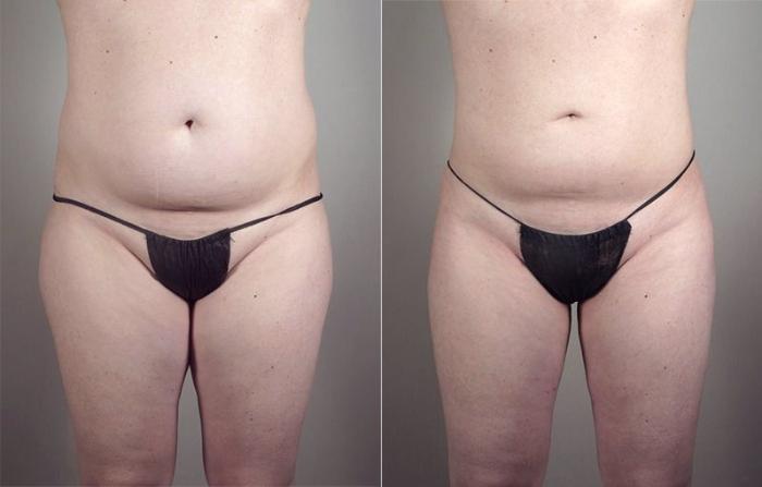 Liposuction Case 801 Before & After View #1 | Paramus, New Jersey | Parker Center for Plastic Surgery