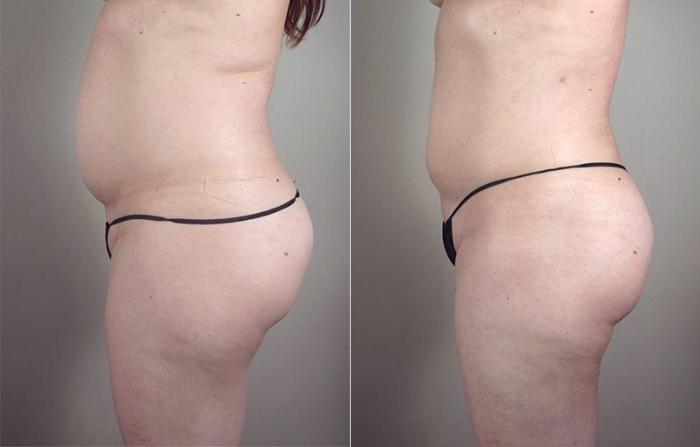 Liposuction Case 801 Before & After View #2 | Paramus, New Jersey | Parker Center for Plastic Surgery