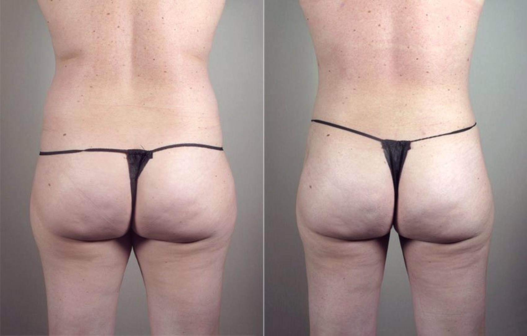 Liposuction Case 801 Before & After View #3 | Paramus, New Jersey | Parker Center for Plastic Surgery