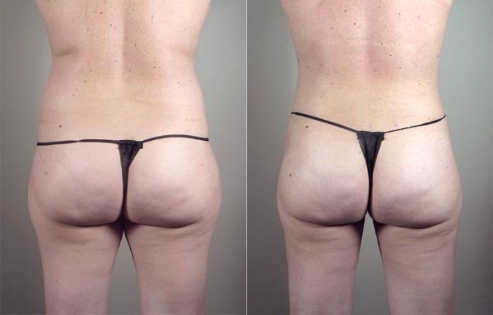 Liposuction Case 801 Before & After View #3 | Paramus, New Jersey | Parker Center for Plastic Surgery