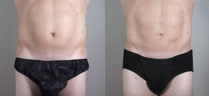 Liposuction Case 802 Before & After View #1 | Paramus, New Jersey | Parker Center for Plastic Surgery