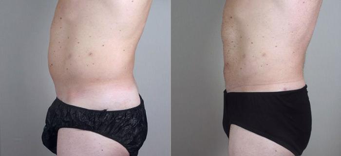 Liposuction Case 802 Before & After View #2 | Paramus, New Jersey | Parker Center for Plastic Surgery