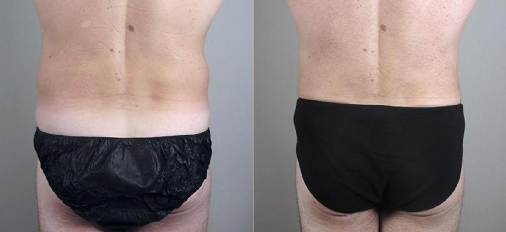 Liposuction Case 802 Before & After View #3 | Paramus, New Jersey | Parker Center for Plastic Surgery